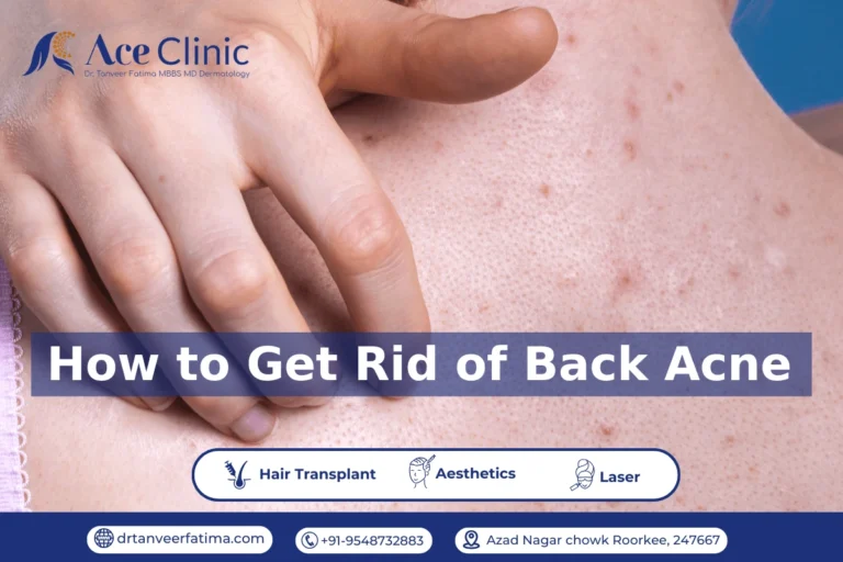 Close-up of back acne with text overlay How to Get Rid of Back Acne by Ace Clinic, Roorkee.