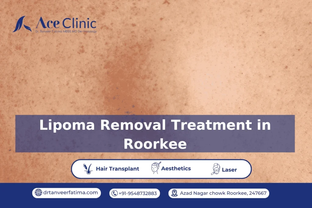 Laser lipoma removal treatment at Ace Clinic, Roorkee by Dr. Tanveer Fatima – safe, effective, and minimally invasive skin care solution.