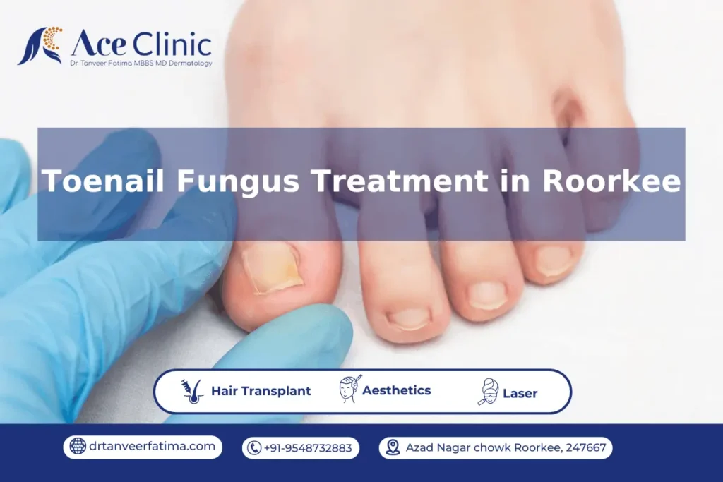 Toenail fungus treatment in Roorkee with Dr. Tanveer Fatima at ACE Clinic, showing expert care for healthy nails