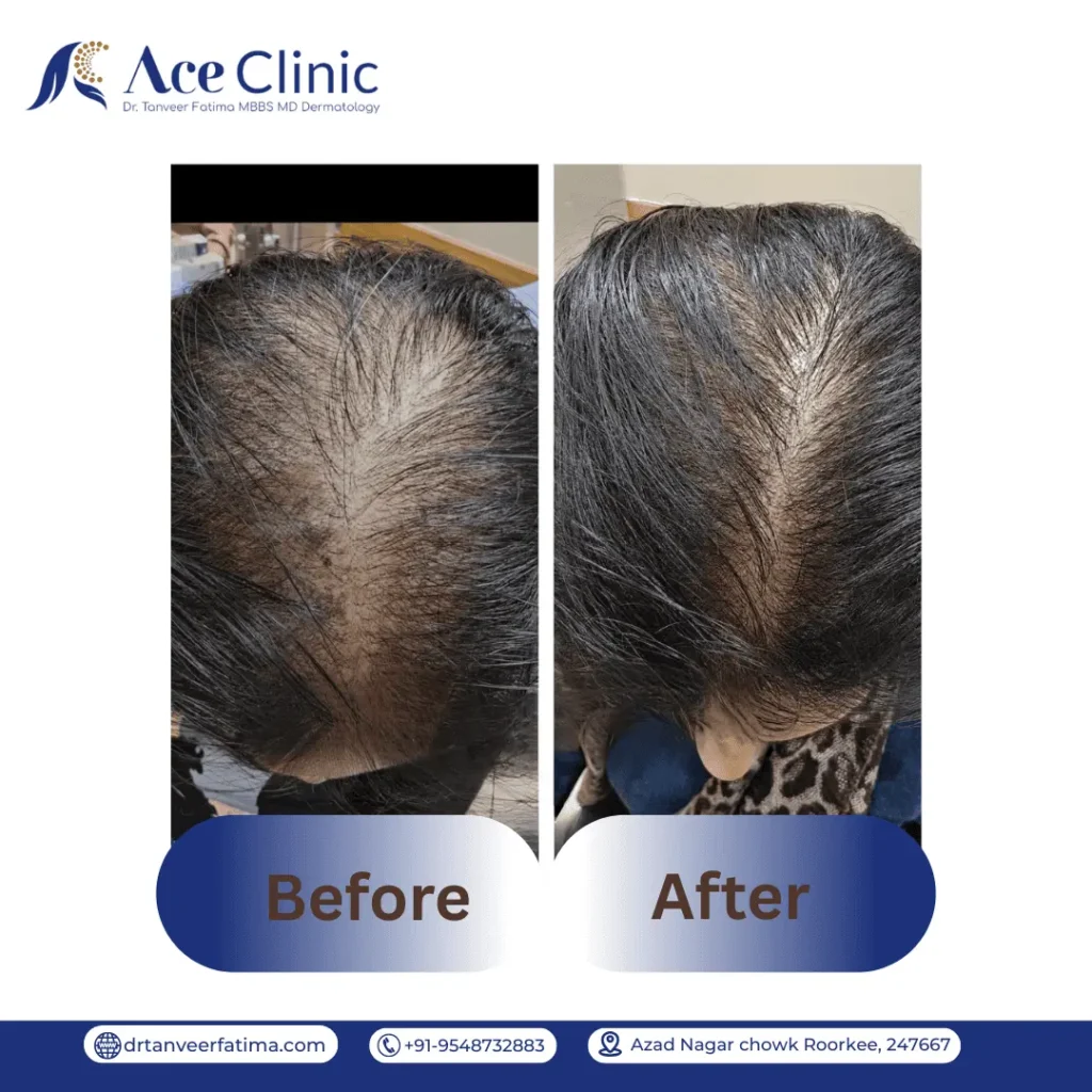 Before and after result of GFC treatment for Telogen Effluvium (TG) hair loss in Roorkee at Ace Clinic performed by Dr. Tanveer Fatima, showing improvement in hair growth and reduction in hair thinning.