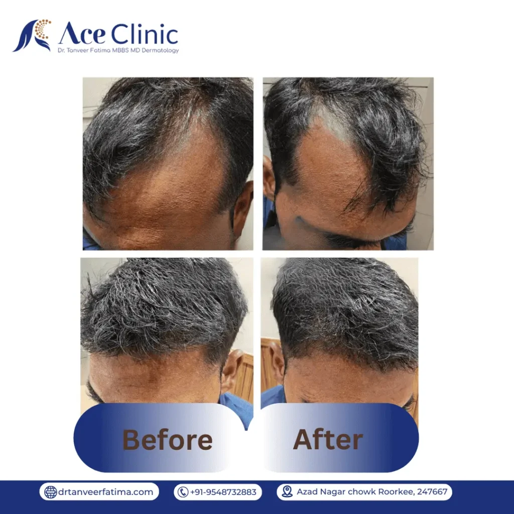 Hair transplant treatment result before and after at Ace Clinic by Dr. Tanveer Fatima showing visible hair regrowth and improved hairline after hair restoration procedure in Roorkee.