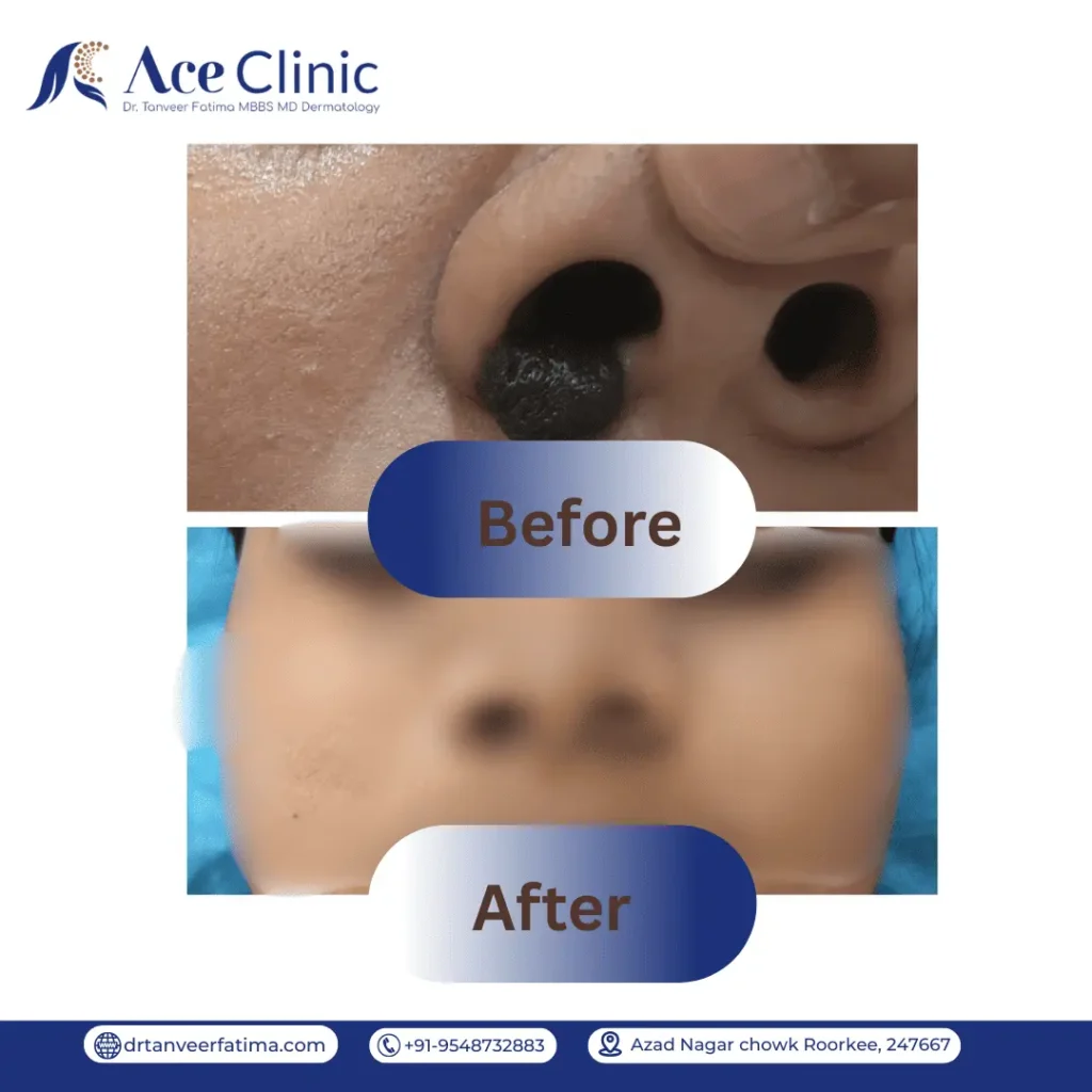 Before and after results of mole excision treatment in Roorkee at Ace Clinic performed by Dr. Tanveer Fatima showing successful removal of a mole from the nose with improved skin appearance.