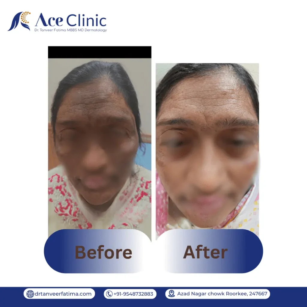 Before and after result of pigmentation LLP treatment at Ace Clinic in Roorkee performed by Dr. Tanveer Fatima, showing improvement in nose pigmentation after dermatology treatment.